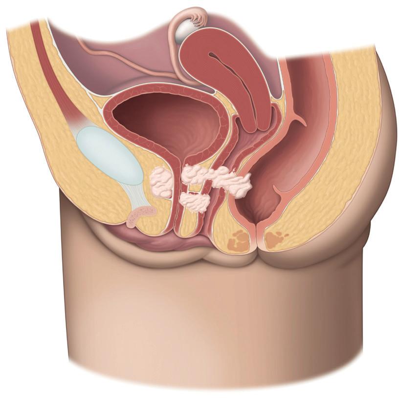 Bladder T2 T3 T4 Vaginal canal Treatment for men with localised urethral cancer Localised primary urethral cancer is confined to the urethra. Treatment for men and women differs.