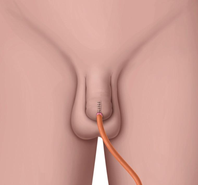 Bladder Partial urethrectomy Partial urethrectomy: If your cancer is limited to the part of the urethra nearest the opening, but still close to the tip, partial removal of the urethra (urethrectomy)