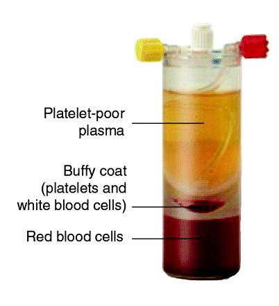 Platelet Rich Plasma (PRP) Derived from patients own blood Centrifuged 4