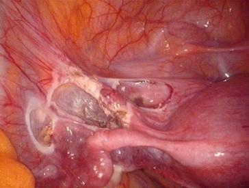 Peritoneum is grasped, dissected from underlying