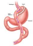 Common Bariatric Surgery Procedures Effect of