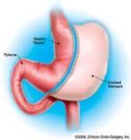 Gastric Bypass Gastric Banding Sleeve Gastrectomy