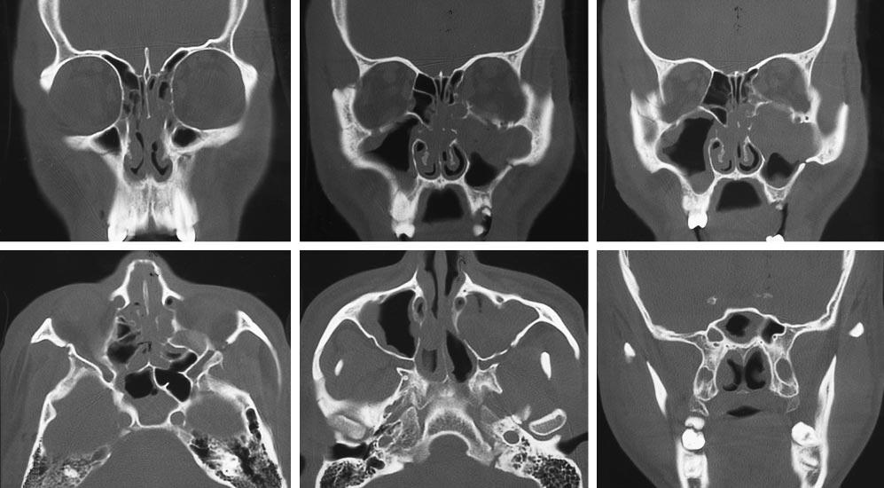 A B C D E F Figure 3. Case 1. Computed tomographic (CT) scans of a 28-year-old man who received multiple manual facial assault impacts.