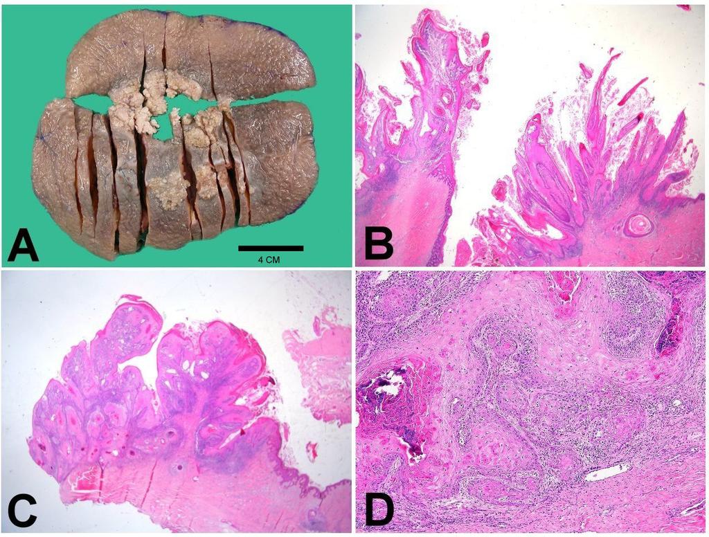 Su & Chang / E-Da Medical Journal 2016;3(2):24-28 Fig. 3 (A) Gross specimen from wide excision showing verrucous hyperplasia of skin. Low-power magnification (12.