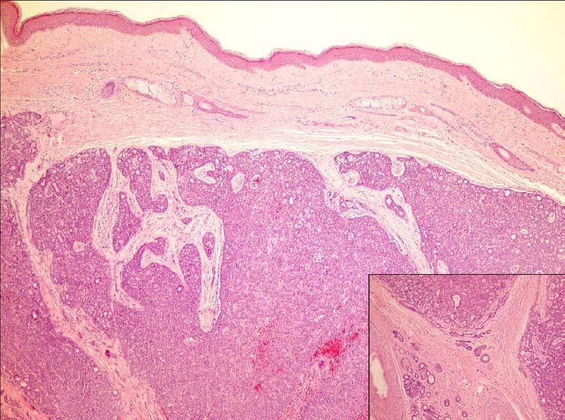 Page 3 of 5 Figure 1 Dermal tumor showing cribriform, tubular and