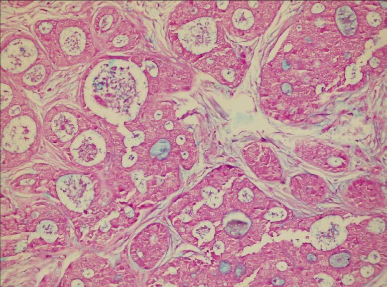 Inset, infiltrating component of the tumor (H&E, x100).