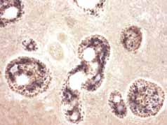Thus, P63 hs een considered to e relile mrker of myoepithelil cells even in the presence of cytomorphologicl heterogeneity (13).