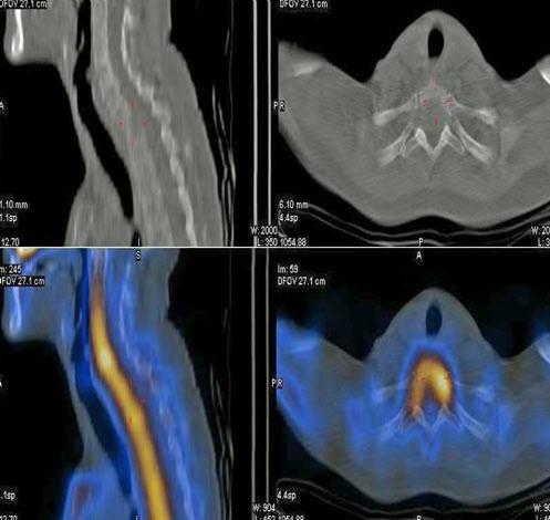 PJNM 2016, Volume 6, Number 1 50 Figure 3 Axial and sagittal SPECT-CT scan images showing increased uptake in the 7th cervical and 1st thoracic vertebrae Figure 5 Sagittal MRI scan showing the lesion