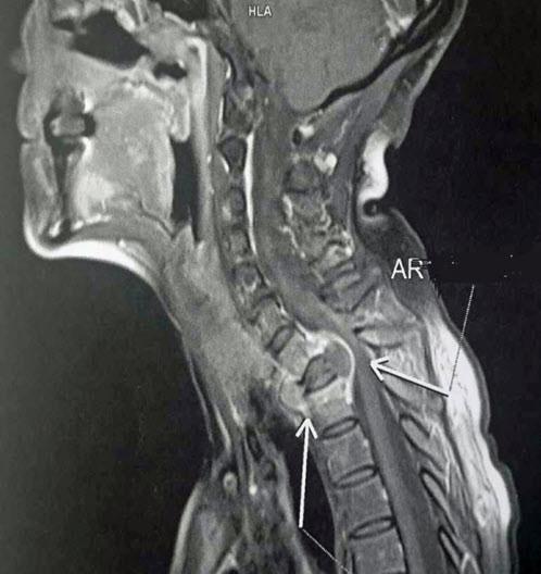 Histopathological examination revealed a metastasis of the known ACC of the maxillary sinus in the vertebral column. Palliative local radiotherapy with chemotherapy was initiated.