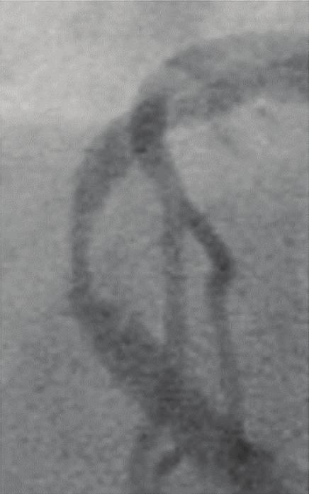 (CAG). CAG after first stenting.