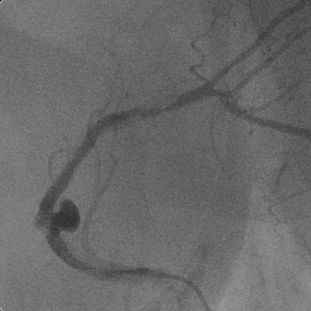 Surgical treatment and a PTFE-covered stent deployment were considered for this case.