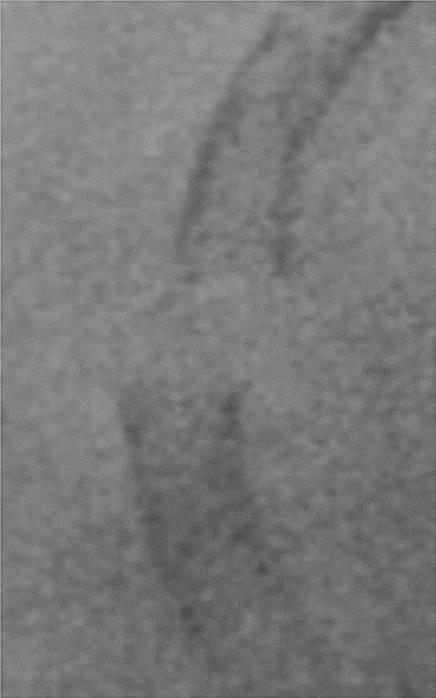 technique. If repeated stenting for stent fracture was performed, stent fracture might occur repeatedly, leading to lethal stent thrombosis or blow-out rupture of the pseudoaneurysm.