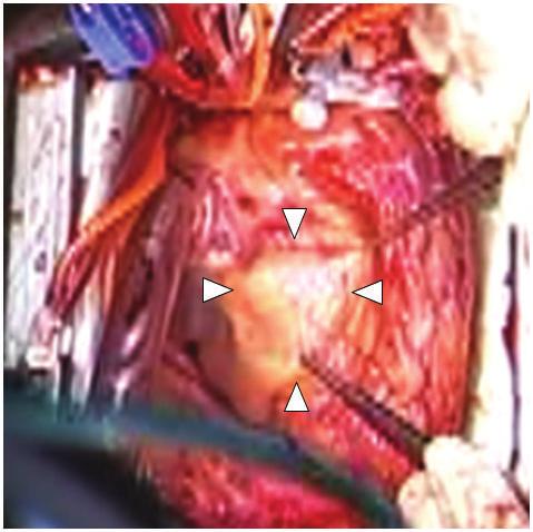 4 Case Reports in Cardiology (c) (d) Figure 5: Intraoperative findings. The pseudoaneurysm is in the visceral adipose tissue (arrow heads) and opened. (c) Coronary arterial transection.