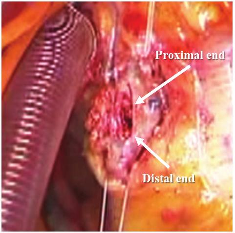 , Clinical outcomes and optimal treatment for stent fracture after drug-eluting stent implantation, Cardiology, vol. 53, no. 3, pp.422 428, 2009. [2] G. Nakazawa, A. V. Finn, M. Vorpahl et al.