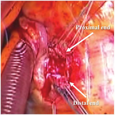 Parikh, A. Hamdan, and M. Bikkina, Coveredstent treatment of coronary aneurysm after drug-eluting stent placement, Texas Heart Institute Journal, vol. 37, no. 4, pp.449 454, 2010. [5]A.Maroo,P.A.Rasmussen,T.