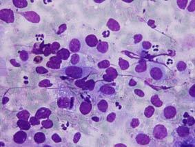 CYTOLOGICAL CRITERIA OF MALIGNANCY MALIGNANT* High cellularity Loss of cohesiveness Nuclear pleomorphism Dirty