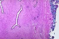 CYTOLOGICAL INTERPRETATION Fibroadenoma It is the most common benign tumour of the