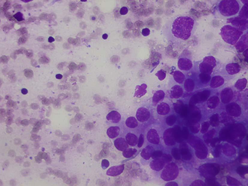 The neoplastic cells are large, pleomorphic with prominent nucleoli. Background rich in lymphocytes.