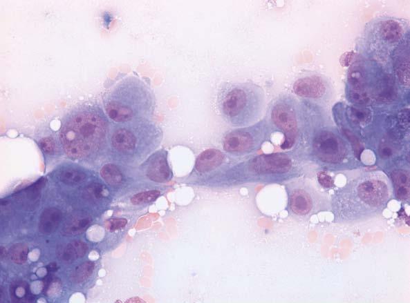 Neoplastic cells are isolated, sometimes