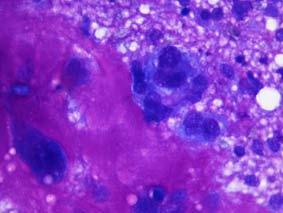 CYTOLOGICAL INTERPRETATION Metaplastic carcinoma Is an invasive ductal carcinoma with metaplastic changes: squamous cells, spindle cells, osteoid or chondroid.