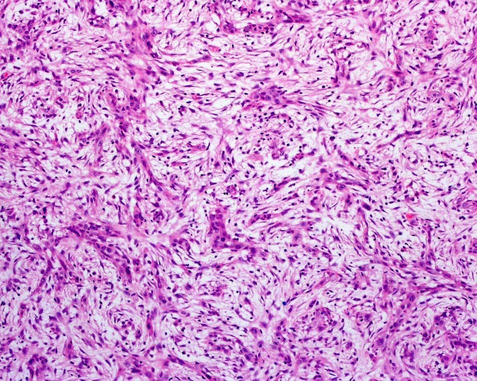 carcinomas of the breast Reis
