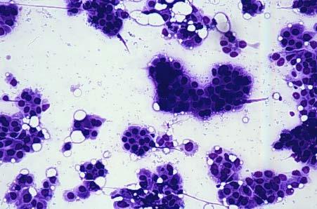 CYTOLOGICAL INTERPRETATION Invasive micropapillary carcinoma Highly cellular smears composed