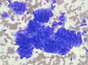 CYTOLOGICAL INTERPRETATION Papillary carcinoma Is it possible to distinguish benign and malignant