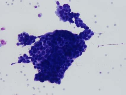 CYTOLOGICAL INTERPRETATION Epithelial proliferative lesions Moderate to high cellularity.