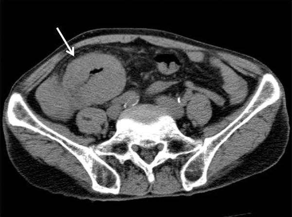 Sarcomatoid Carcinoma of the Small Intestine A B C D Fig. 1. CT images in a 70-year-old man with abdominal pain.