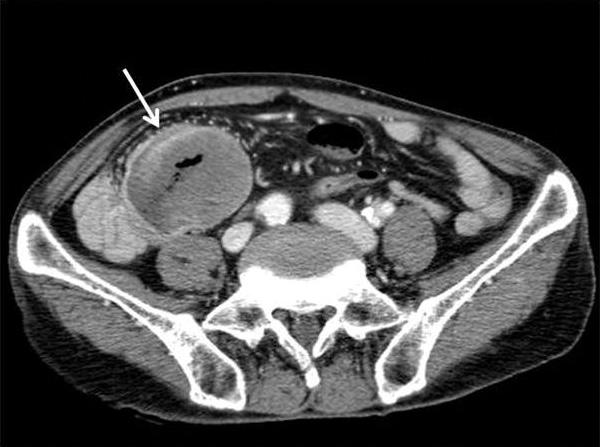 abdominal MDCT scan demonstrated a well-defined, roundshaped, exophytic growing mass with central necrosis, which measured 6 cm in greatest dimension of the mid jejunum.