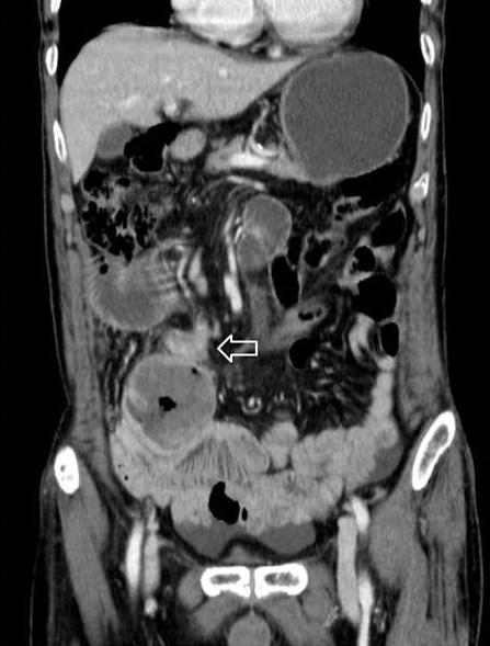 1). We presumed the small bowel obstruction caused by tumor seeding adjacent proximal jejunum.