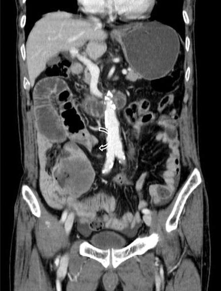 There was no significant lymphadenopathy. Considering the abovementioned CT features, the patient was diagnosed as adenocarcinoma in jejunum.