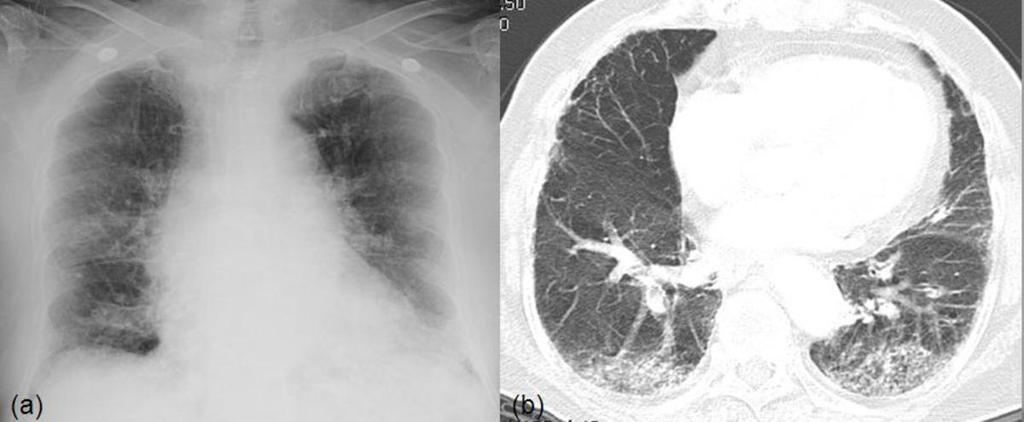 The sensitivity in diagnosing pneumonia were 80.9% on CXR and 100 % on LDCT. The specificity were 92.8% on CXR and 89.9% on LDCT. Positive predictive value were 95.7% on CXR and 95.1 % on LDCT.