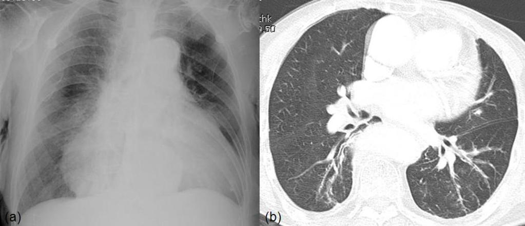 Fig. 3: A 91-year-old woman with bronchitis. Supine chest radiograph shows cardiomegaly. LDCT shows diffuse bronchial wall thickening in both lower lungs.
