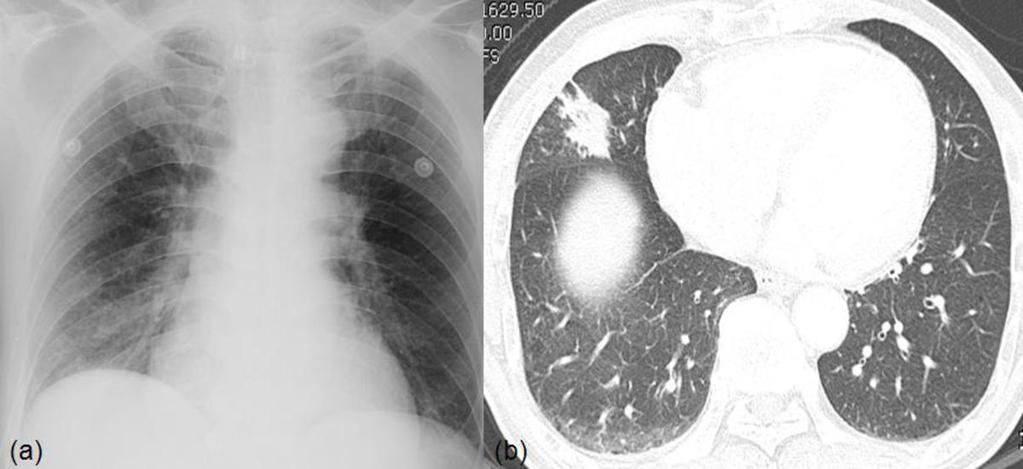 Fig. 4: A 72-year-old man with pneumonia. (a) Supine chest radiograph shows suspicious opacity in right lower lung zone. (b) LDCT shows consolidation in RML.