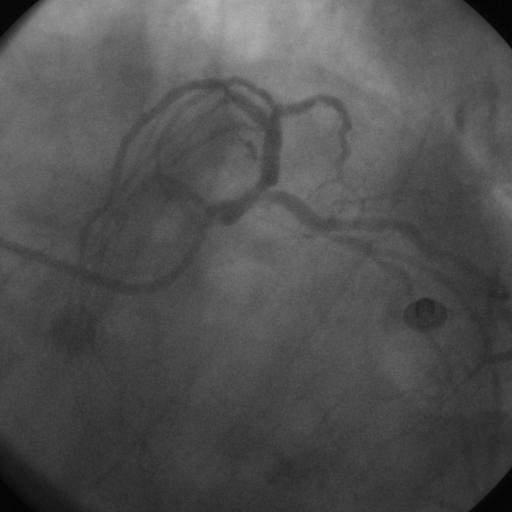 The impact of Main Branch Restenosis on Long Term Mortality