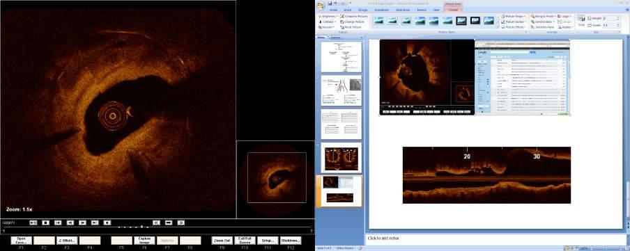 Optical coherence tomography assessment of in-stent restenosis after percutaneous