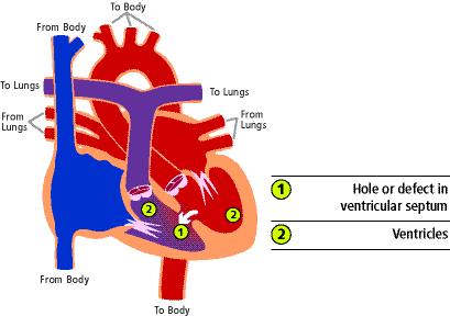 2. Ventricular Septal Defect (VSD) Ventricular septal defect is the most common congenital heart defect and accounts for 20-30% of children seen in paediatric cardiology clinics.