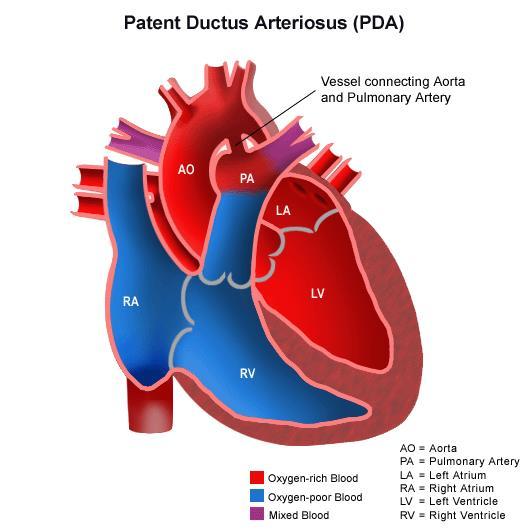 3. Patent Ductus Arteriosus (PDA) Patent ductus arteriosus (PDA) is a condition in which the connecting blood vessel between the pulmonary artery and the aorta in foetal circulation, called the