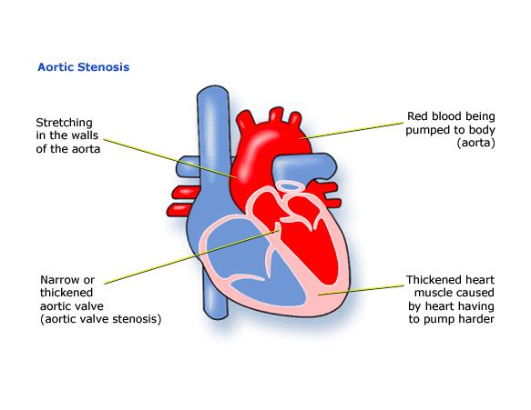 Suitable contraception 4. Aortic Stenosis (AS) Aortic stenosis is a narrowing of the aortic valve. This means that the flow of blood from the left ventricle into the aorta is less efficient.