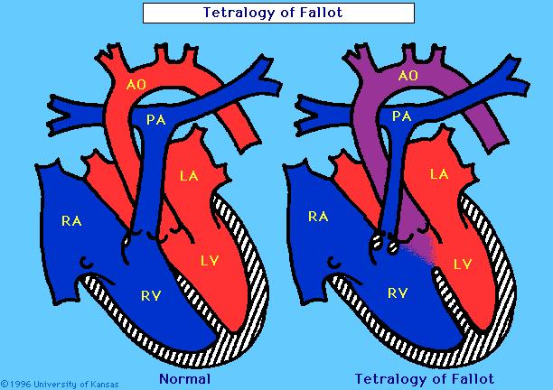 7. Tetralogy of Fallots Tetralogy (Greek-four) of Fallot (named after Etienne-Lois Arthur