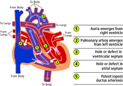 8. Transposition of the Great Arteries Complete transposition of the great arteries (TGA) occurs when the aorta, which normally leaves the left ventricle and pumps red blood to the body, arises from