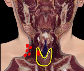 Thyroid Cancer Anaplastic