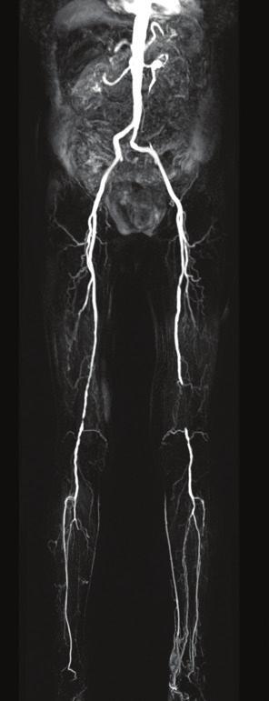 Prevention and Management of CLI Complications Interventionists must be aware of and prepared to treat complications that can occur during endovascular treatment of high-risk lesions.