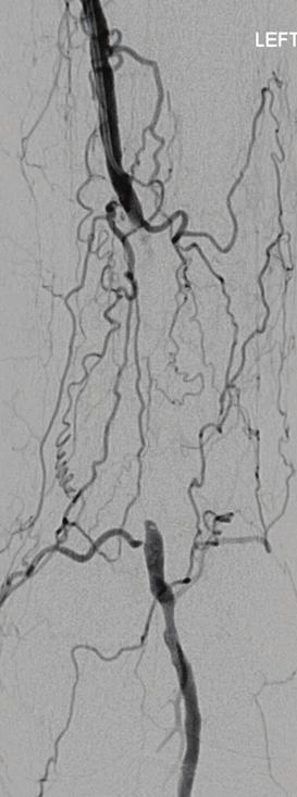 distal runoff Figure 2. A lesion at high embolic risk in the right popliteal artery in a patient with short-distance claudication.