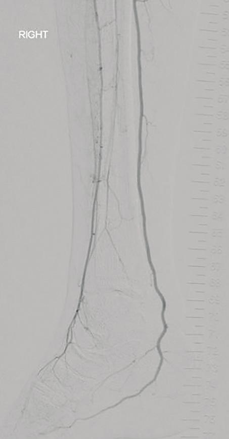 Directional atherectomy with a distal filter in place (arrow)