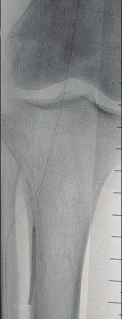 Tibial artery anatomy following filter removal (D).