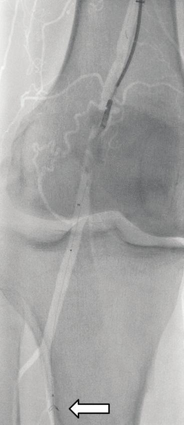 complications in a 79-year-old man with a nonhealing right