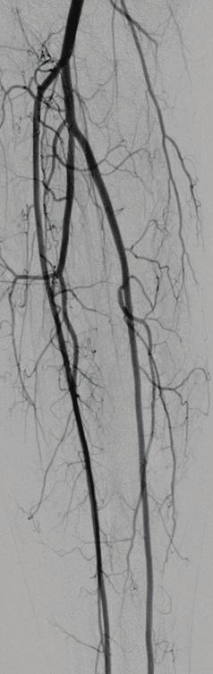 Initial angiography showing a tibioperoneal trunk occlusion