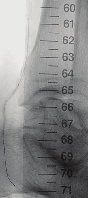 Angioplasty and a drugeluting stent were used to treat the peroneal artery lesion (B). The peroneal artery was revascularized (C).